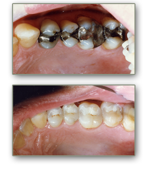 henderson dental inlays and onlays