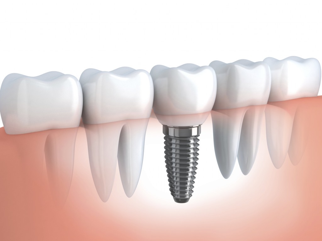 implant diagram