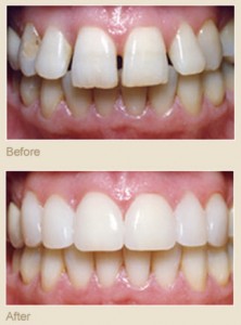 porcelain-veneers