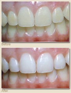 teeth-whitening-henderson-nv