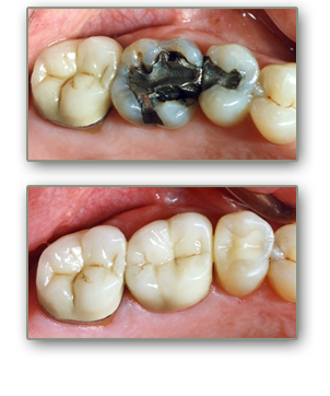 henderson dental bridges