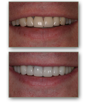 dental crowns henderson