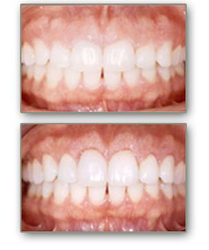 cosmetic gum sculpting henderson