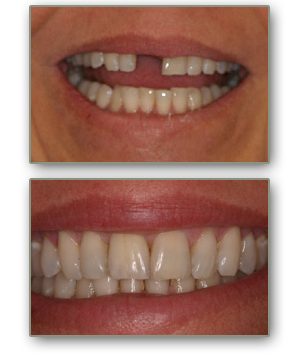 dental implants henderson