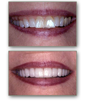 dental veneers henderson nv