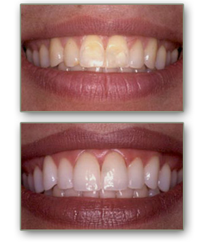 teeth whitening henderson nevada